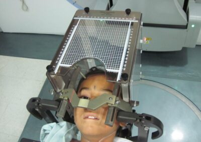 Sistema de marco invasivo Leksell de titanio para radiocirugía de dosis única